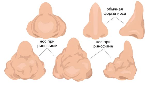 Обычная форма носа и нос при ринофиме Обычная форма носа и нос при ринофиме