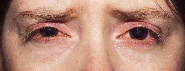 Офтальморозацеа [21]