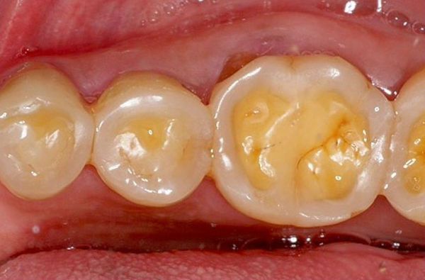 Эрозия жевательной поверхности зубов