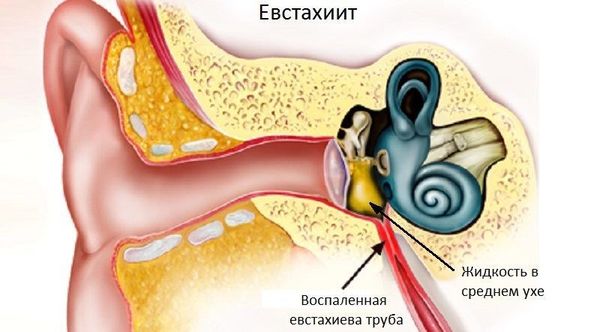 Комплекс упражнений при тубоотите