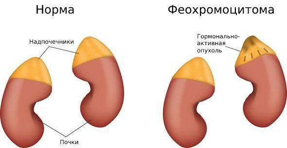 Феохромоцитома 