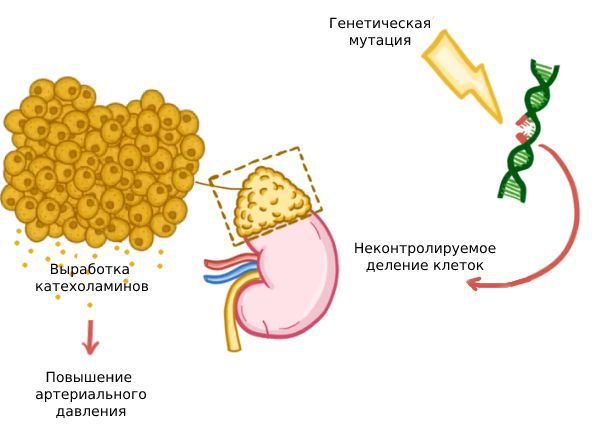 Развитие феохромоцитомы