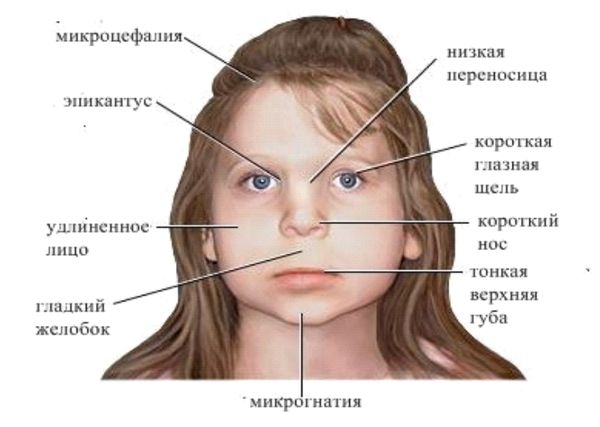 Внешние признаки фетального алкогольного синдрома