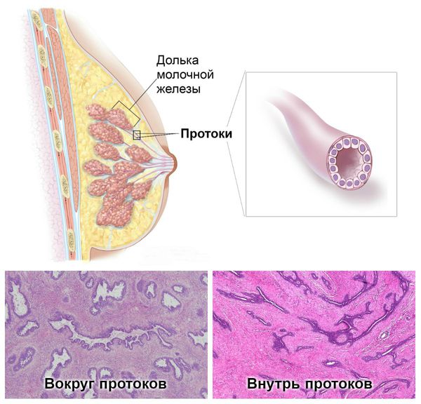Протоки молочной железы: периканаликулярная и интраканаликулярная фиброаденома