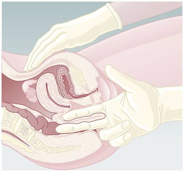 Бимануальное ректовагинальное исследование