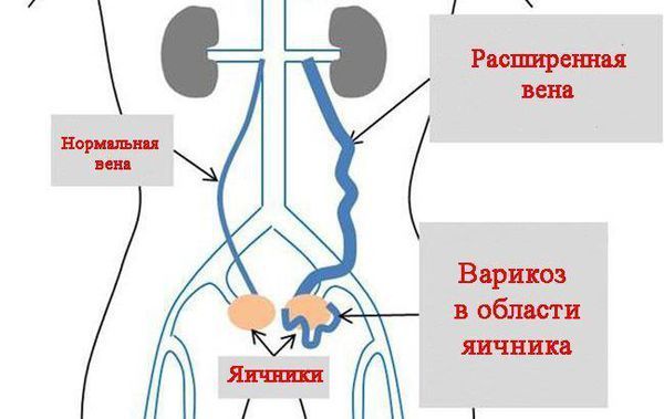 Варикоз вен малого таза