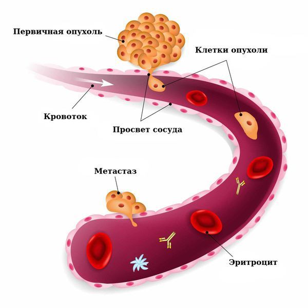Распространение опухоли через кровеносную систему