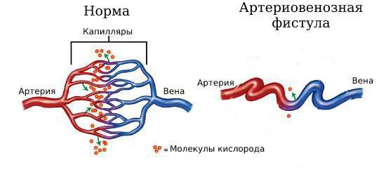 Нормальные сосуды и артериовенозная фистула
