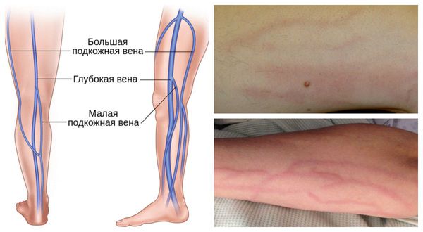 Флебит в бассейнах малой и большой подкожных вен