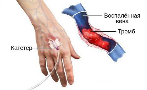 Тромбофлебит подкожных вен