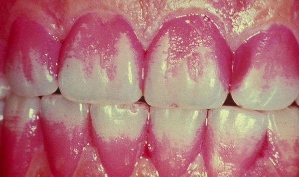 Метод витального окрашивания эмали зуба