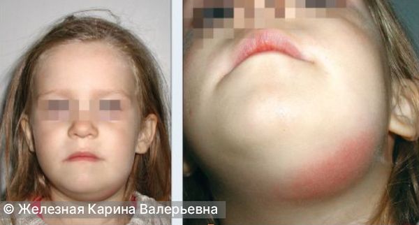 Одонтогенная флегмона поднижнечелюстной области