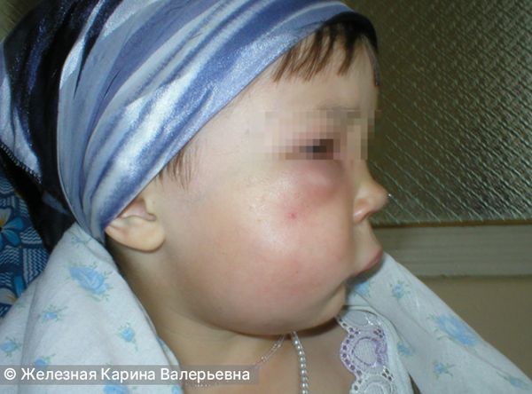 Острый одонтогенный остеомиелит верхней челюсти