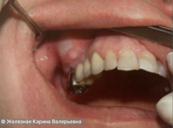 Сглаженная переходная складка у «причинного» зуба