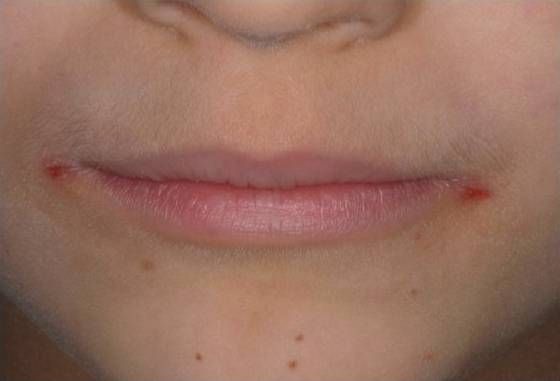 Ангулярный стоматит [23]