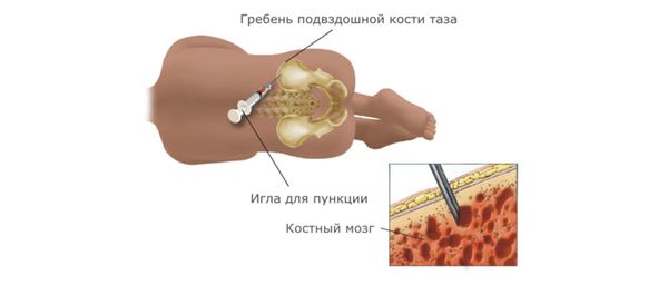 Аспирационная пункция