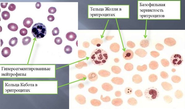 В12 фолиеводефицитная анемия картина крови