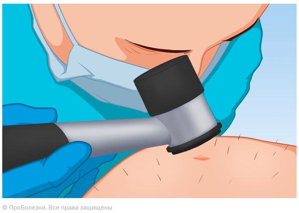 Дерматоскопия