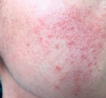 Эритематозные участки с фолликулярными папулами на щеке [21]