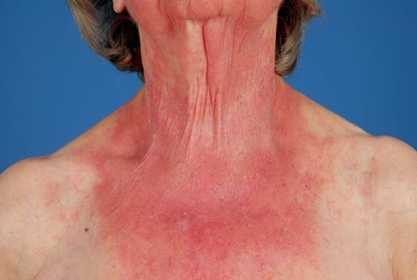 Фотоаллергическая реакция кожи [5]