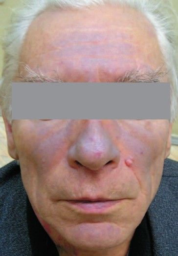 Фотодерматит на фоне приёма Амиодарона [2]