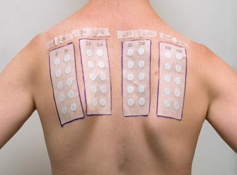 Фотопатч-тестирование [23]