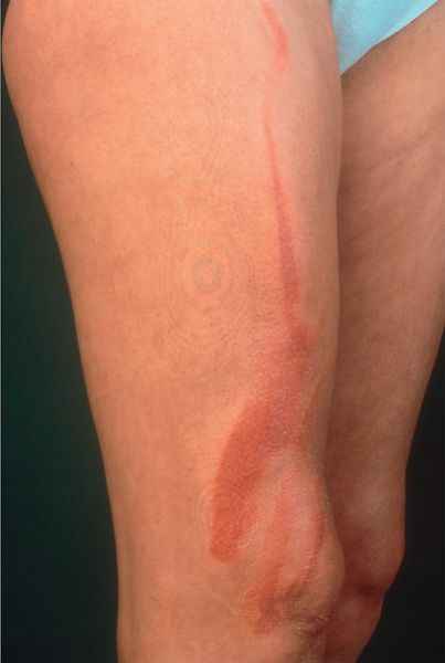 Фототоксическая реакция кожи (покраснение) после контакта с кустом и воздействия УФ-излучения [5]