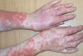 Фототоксическая реакция на Доксициклин [11]