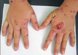 Поздняя кожная порфирия [22]