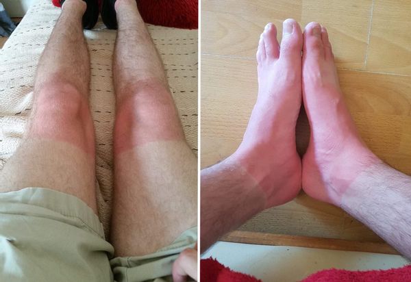 Солнечная крапивница [21]