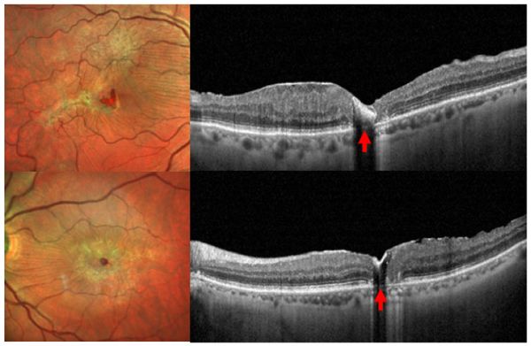 Наружное ретинальное отверстие в фовеа, характерное для хронической солнечной ретинопатии [1]