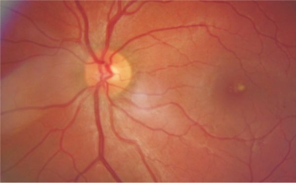 Жёлтое пятно на глазном дне макулы (справа) [15]