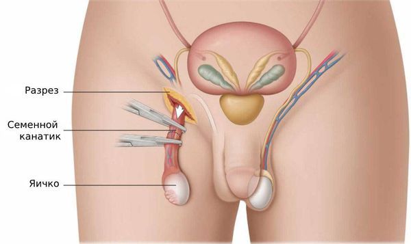 Удаление семенного канатика, яичка и его придатка
