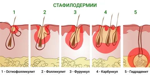 Стафилодермии, которые нужно различать Стафилодермии, которые нужно различать