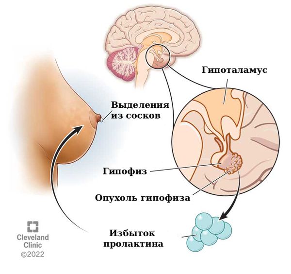 Механизм галактореи при пролактиноме [17]
