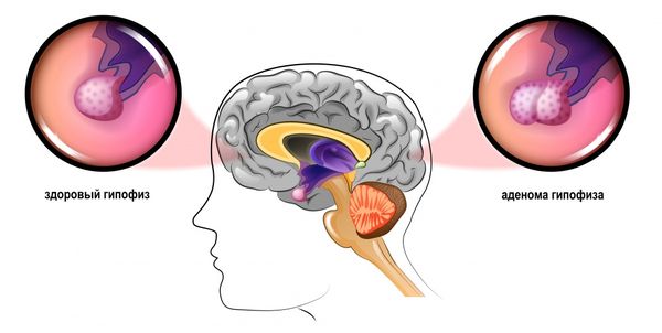 Опухоль гипофиза