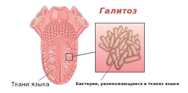 Бактерии на языке