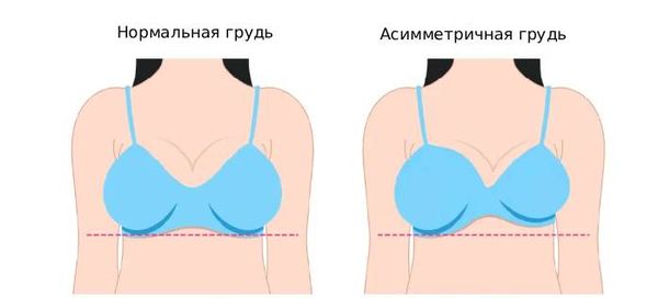 Асимметрия груди