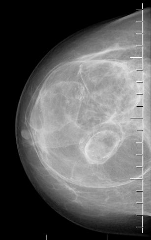 Гамартома молочной железы [16]