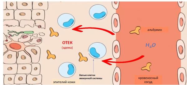 Развитие воспаление после проникновения бактерии