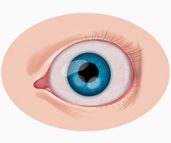 Синдром Пти