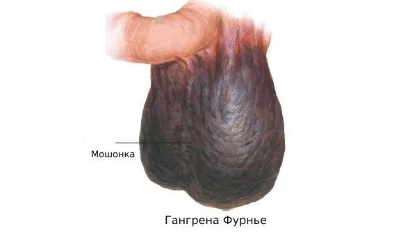 Разрыв вены — одно из самых опасных осложнений варикозной болезни. Как себя защитить?