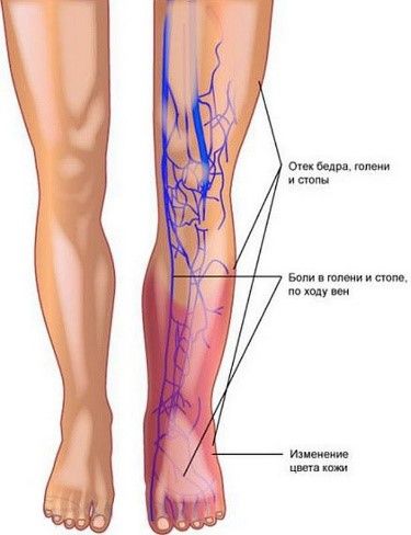 Тромбоз ног