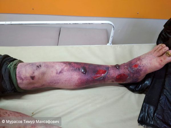 Буллёзно-некротическая форма рожистого воспаления