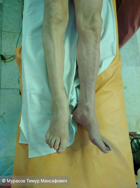 Эмболия артерий левой ноги. Нога холодная, синюшная, без движений и чувствительности в пальцах, с сильной болью. Без лечения началось бы отмирание тканей и развилась гангрена