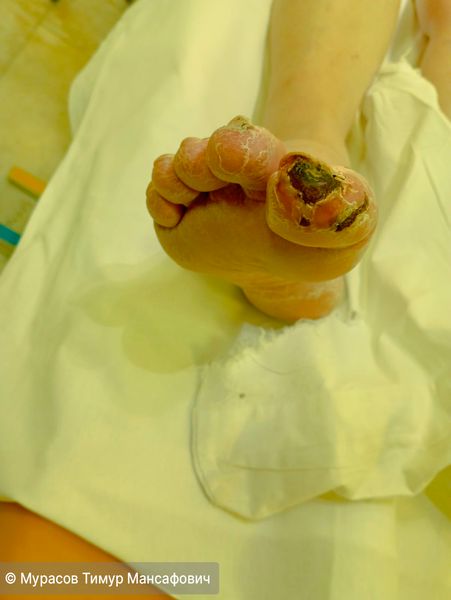 Сухая гангрена большого пальца