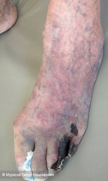 Сухой некроз III, IV, V пальцев, трофическая язва I межпальцевого промежутка. IV,V пальцы уменьшены из-за начавшейся мумификации
