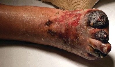 Влажная гангрена [13]