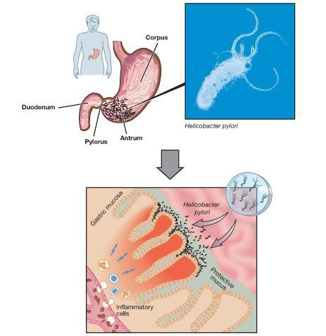 Хроническая инфекция Helicobacter Pylori