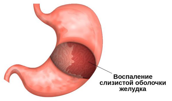 Воспаление слизистой оболочки желудка